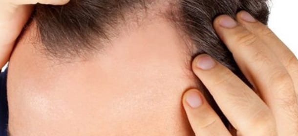 Calvizie: dalle cellule staminali crescono nuovi capelli